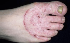 Mantarın bacaklarda ortaya çıkmasının nedenleri