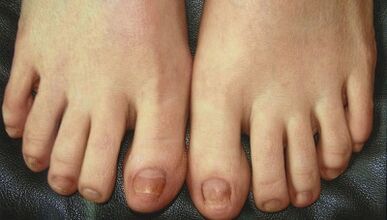 Tırnak mantarının gelişim aşamaları