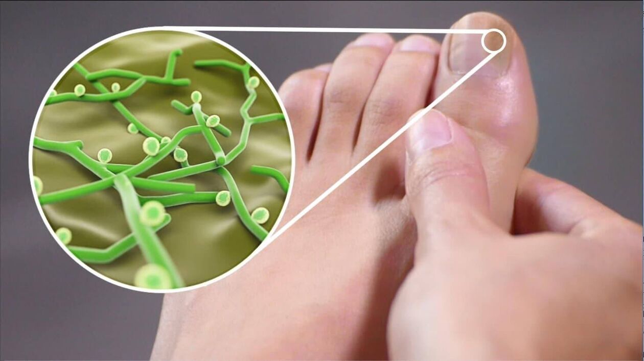 ayak tırnağı mantarının patojenleri