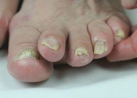 tırnak mantarının ilaçlarla tedavisi