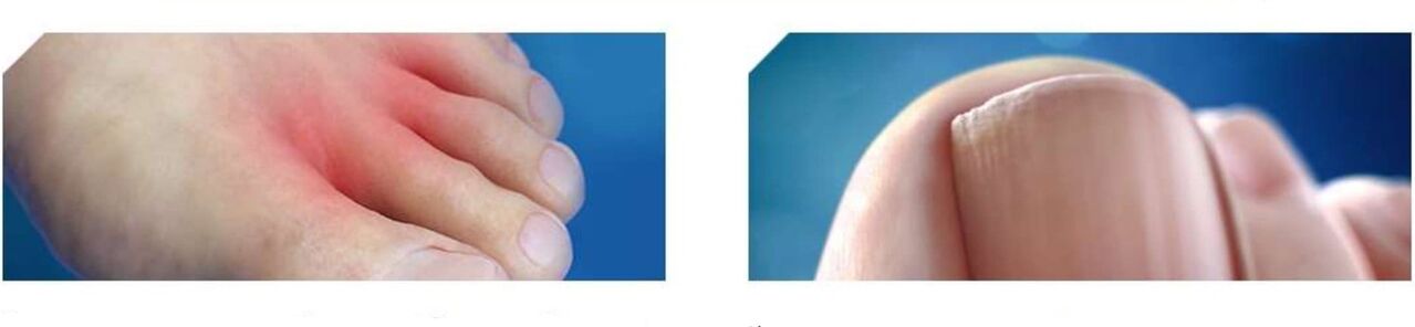 ayak mantarının başlangıç ​​aşaması